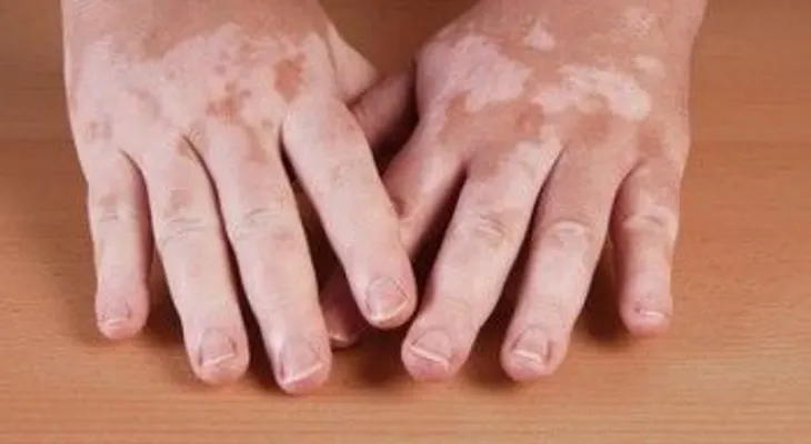 El consumo de nueces y otros 6 remedios para el vitiligo o despimentación de la piel