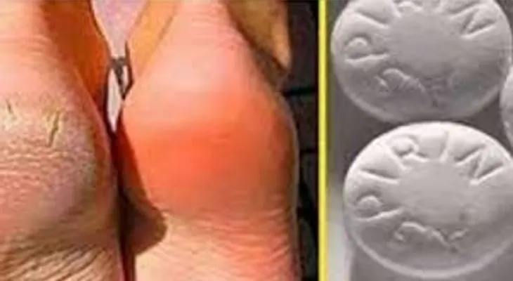10 aspirinas trituradas con alcohol, y los callos, talones agrietados y venas varicosas desaparecerán