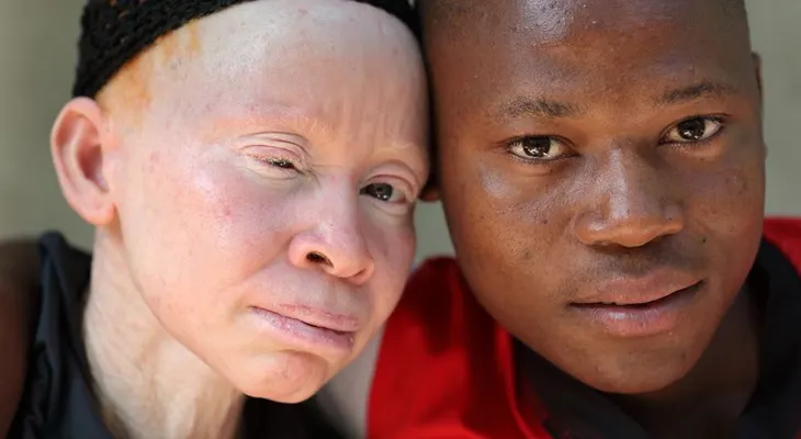 Carnicería humana: el drama de ser albino en África