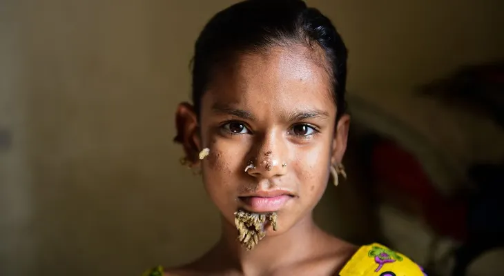 Diagnosticaron a la primera "niña árbol" del mundo: impresionantes verrugas con forma de corteza ya comenzaron a crecer en su cuerpo
