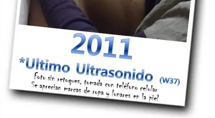 El secreto para eliminar y prevenir estrias !! ATENCION!!!