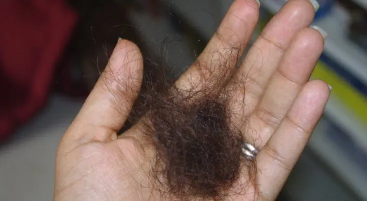 Alopecia una condición que no juzga por sexo u edad 