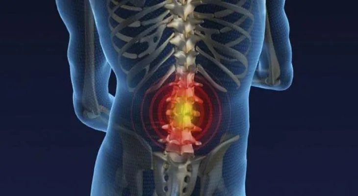 Un disco puede herniarse debido a varias razones