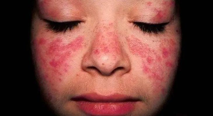 Tratar los síntomas de lupus a tiempo puede evitar afecte órganos y sistema como el riñón 