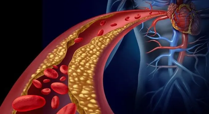 Cómo limpiar las arterias