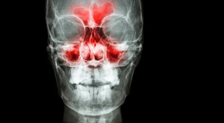 ¿En qué consiste la sinusitis maxilar y cuál es su tratamiento ?