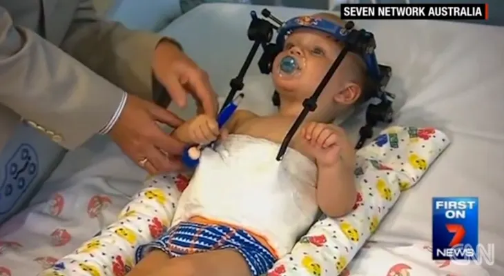 Médicos australianos le salvan la vida a niño que había sido decapitado internamente
