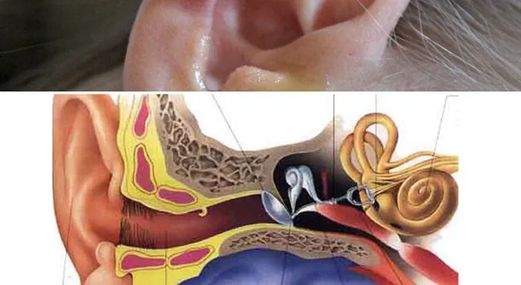 10 remedios que te resuelven el exceso de cera del oído