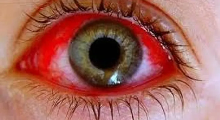 Atribuyen a las lluvias, brote de conjuntivitis afecta el país; muchos niños y adultos afectados 