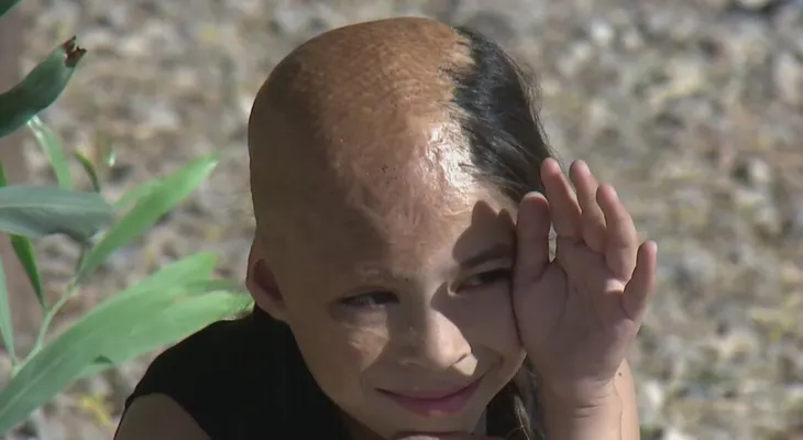 Una niña abandonada por su madre por las quemaduras en su cuerpo