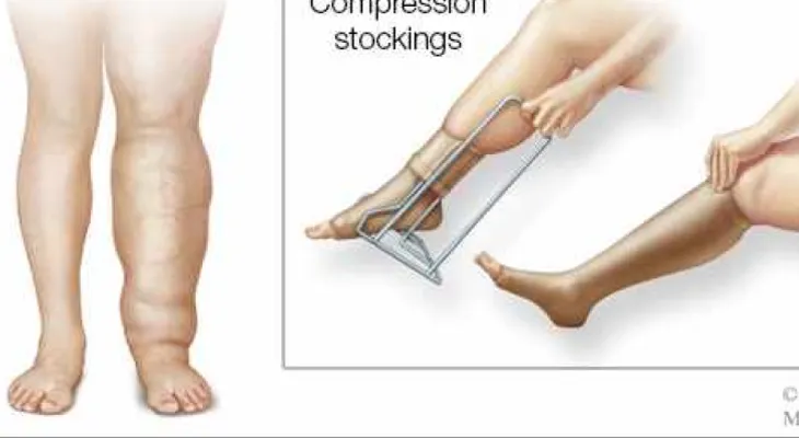 Tratamiento para el linfedema normalmente empieza con vendas y compresión