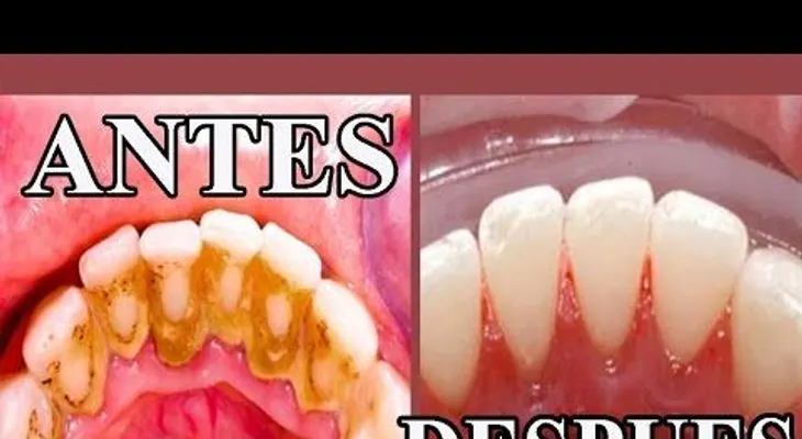 Remedios que FUNCIONAN, para blanquear los dientes!