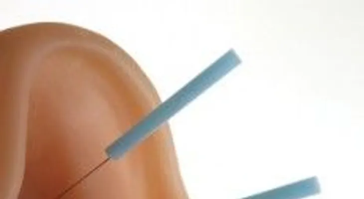 Aplicarte agujas en la oreja para perder peso: la famosa Auriculoterapia