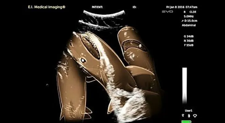 La impresionante ecografía de una hembra de tiburón embarazada
