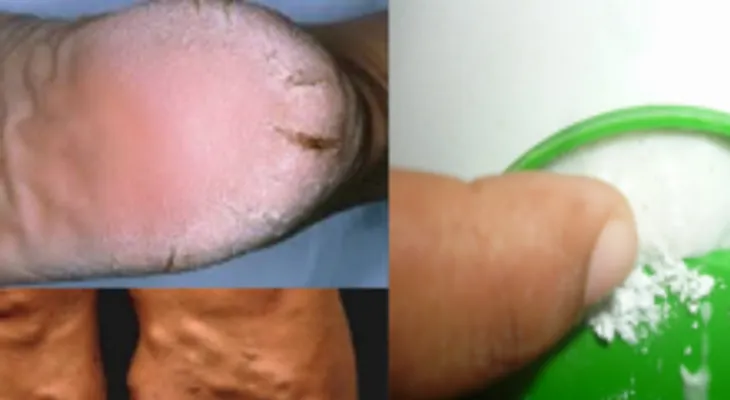 Un milagro: Este remedio cura talones agrietados, callos y las venas varicosas en 10 días