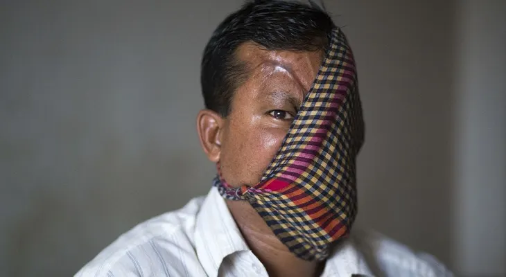 El hombre destrozado por un tigre muestra sus heridas 20 años después