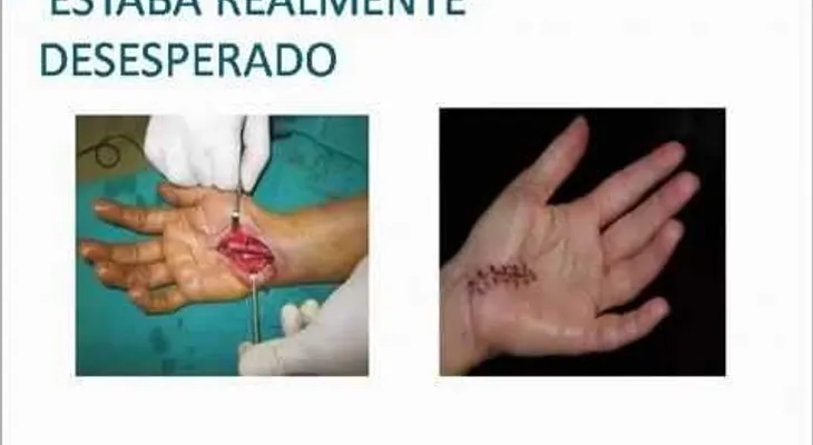 Cura del Sindrome del Tunel Carpiano 100% Natural