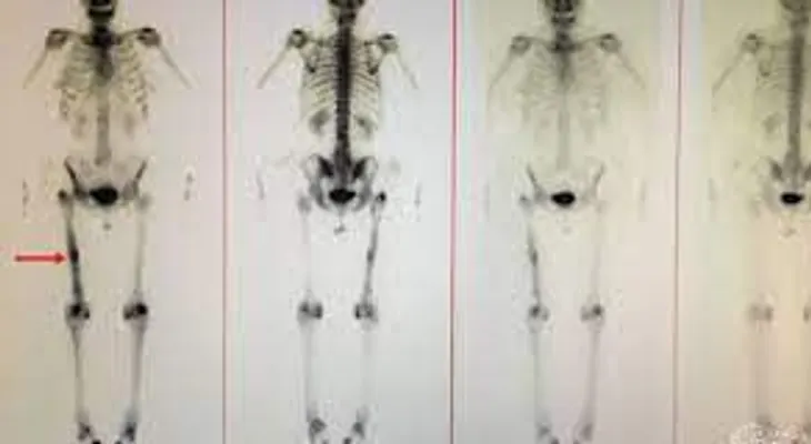Gammagrafía ósea: Es una prueba de medicina nuclear para detectar posible cáncer en los huesos 