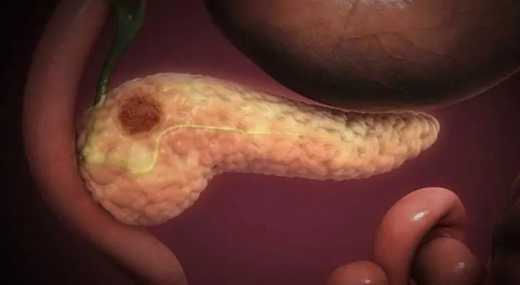 Desarrollan herramienta determinará tipos de quistes serían luego cáncer de páncreas 