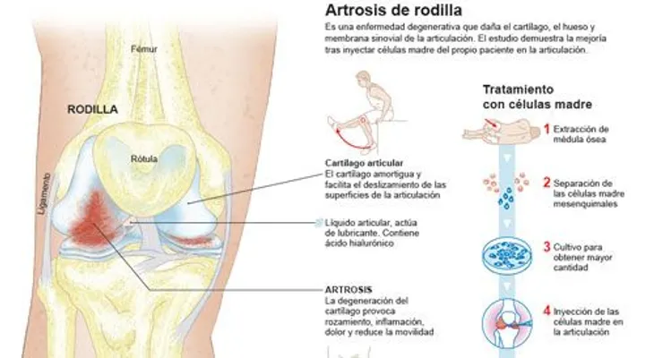 Las células madre para curar la artrosis de rodilla