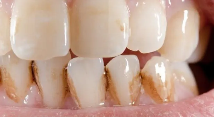 Cómo eliminar el sarro de los dientes naturalmente