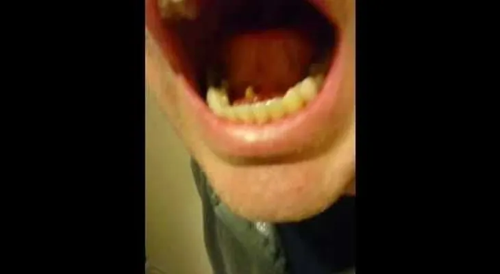 VIDEO FUERTE: Un hombre descubre algo debajo de su lengua 