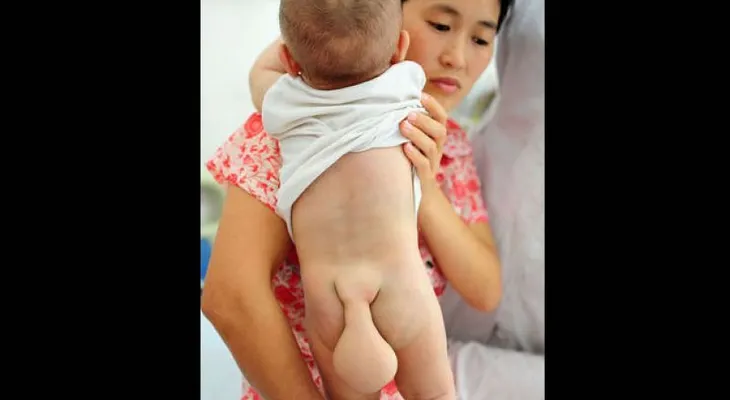 El bebe de 5 meses al que le esta creciendo una cola