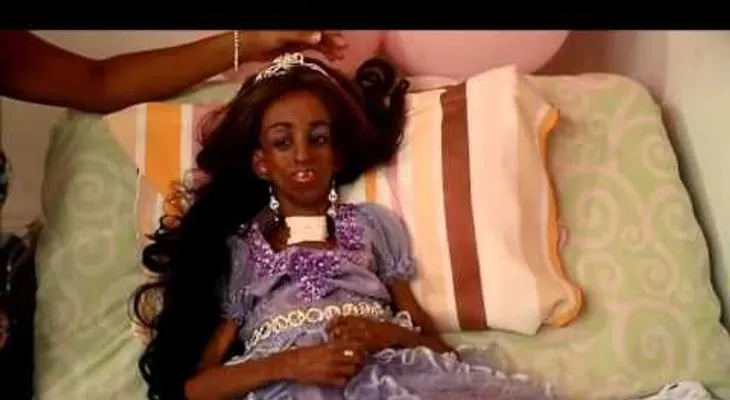 Esta niña tiene 15 años, pero parece de 90 por una rara enfermedad (VIDEO)