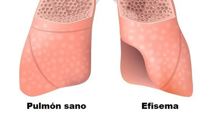 Alimentos que revierten la enfermedad pulmonar obstructiva crónica