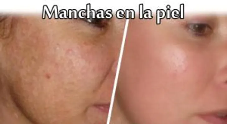 Dile adiós a esta manchas para siempre !!!
