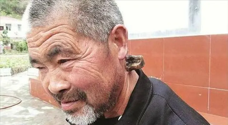 Un hombre lleva 30 años con un ?parásito? en su cuello