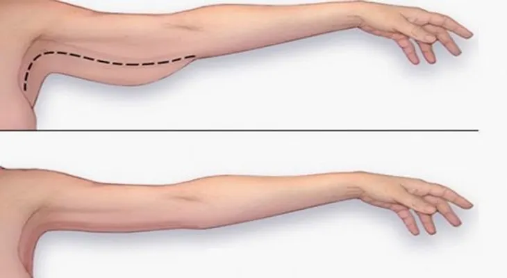 Cómo eliminar la grasa del brazo rápidamente en tu casa sin recurrir a costosas cirugías