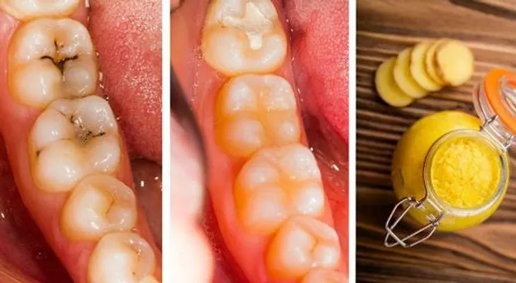 Cure las caries con esta pasta de dientes de gran alcance
