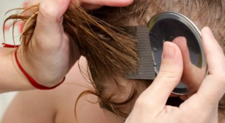 7 remedios para eliminar los piojos y liendres en poco tiempo