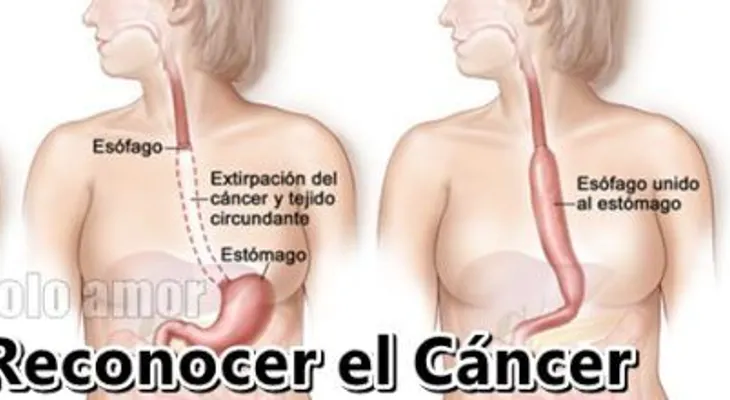 Síntomas de cáncer de estomago: Tiene que ver esto para evitarlo a tiempo