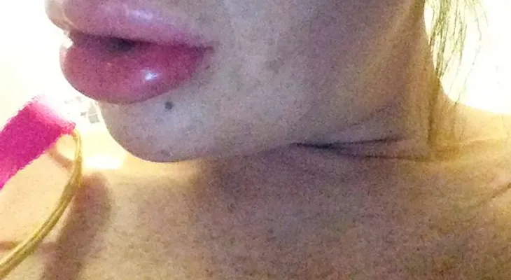 Una mujer se sometió a un tratamiento de relleno de labios y mira como quedó; tuvo que ser hospitalizada