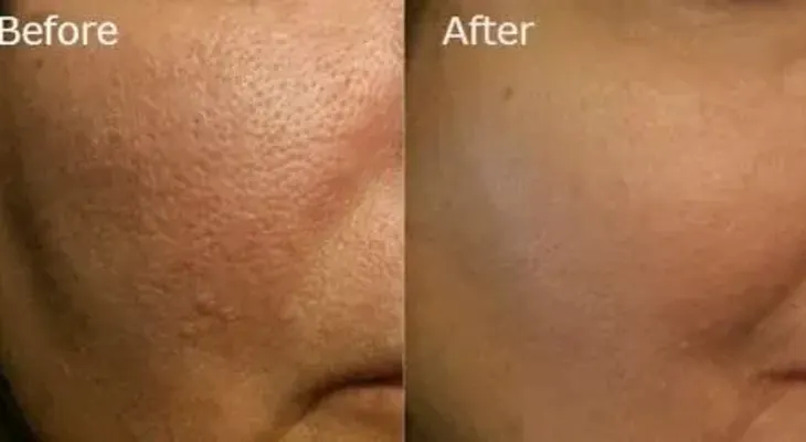 Formas naturales para remover los grandes poros 