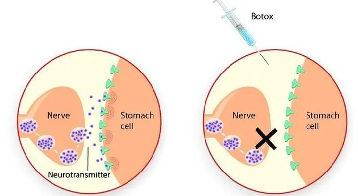 El bótox podría frenar la progresión del cáncer de estómago