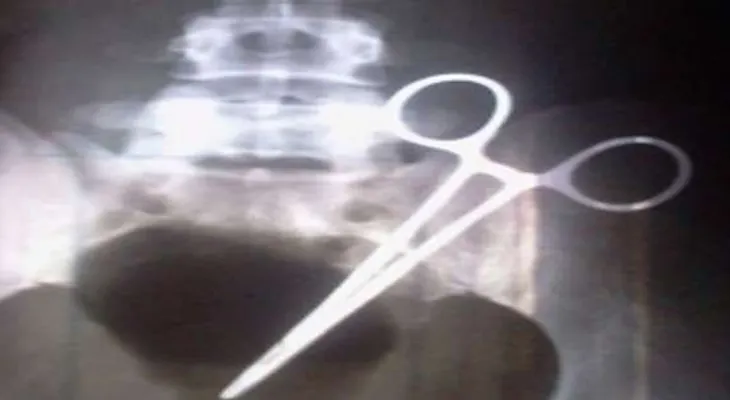 Mujer tiene una tijera en el abdomen hace 9 meses