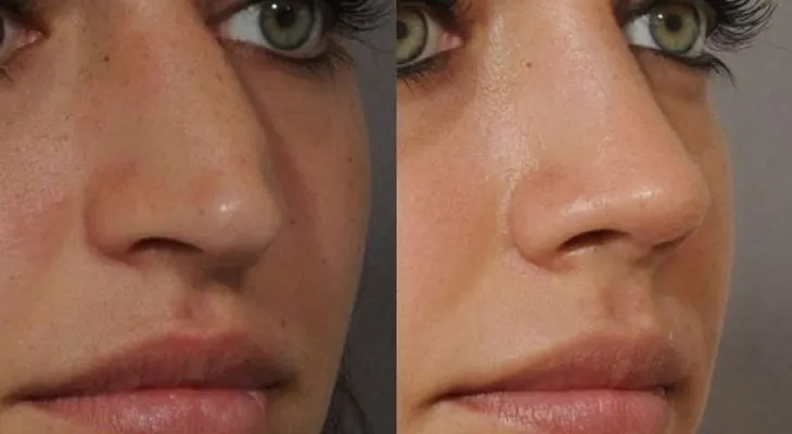 Preguntas más frecuentes sobre la rinoplastia