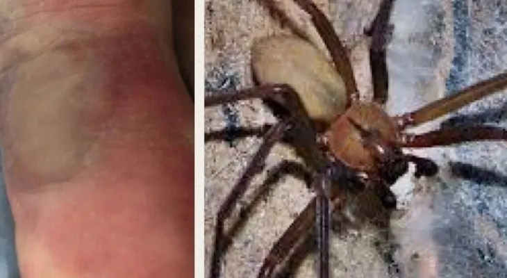 Amputan una pierna a mujer picada por peligrosa araña en EE.UU; la someten a 7 cirugías 