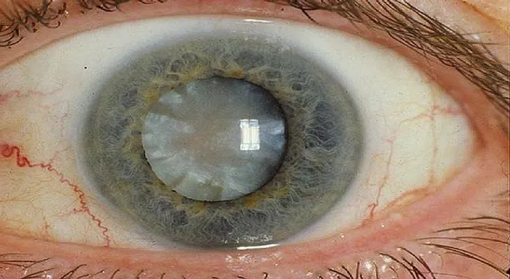 Los científicos desarrollan gotas para los ojos que pueden derretir las cataratas