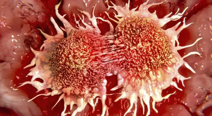  Desinformación y síntomas confusos retrasan diagnóstico de cáncer de próstata 