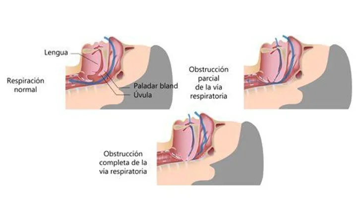 Para dejar de roncar