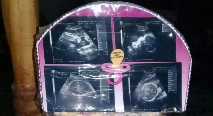 Mujer que esperaba dar a luz gemelas recibió solo una bebé en un hospital de Argentina
