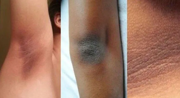 Aprende a eliminar las manchas de codo, axilas y cuello en tan solo minutos!