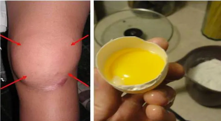 Remedio natural para eliminar el dolor de rodilla y la inflamación en pocos segundos!
