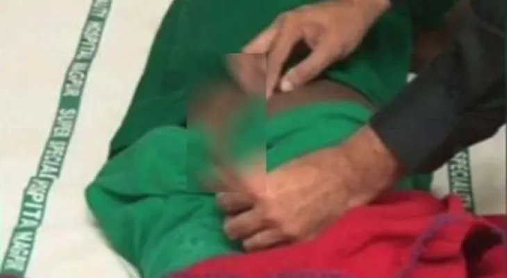 Extirpan el rabo de 18 cm de un hombre, el más largo registrado por la medicina