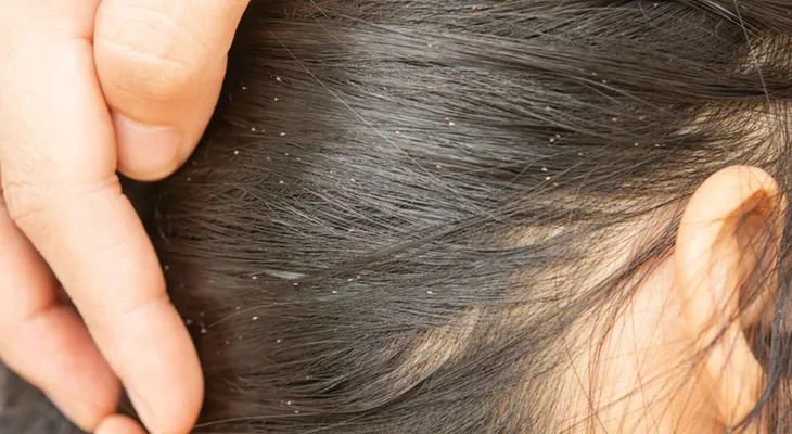 Acaba con los piojos para siempre: 10 consejos 