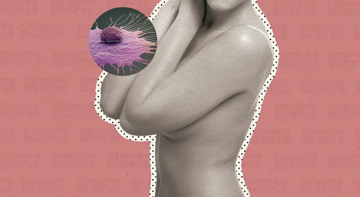 Un gen de células que rodean los tumores, es la clave en avance del cáncer de mama.